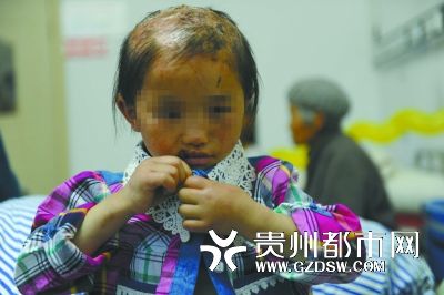 被燙傷的頭皮一直沒有愈合。