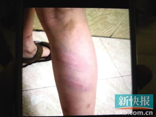 小宇腿部有明顯瘀痕。 翻拍自家屬手機(jī)