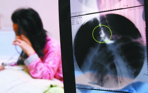 假牙上的鋼絲刺破食管，而薄薄的食道壁緊貼主動脈血管，極易造成血管破裂