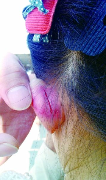 　　女童的耳朵被老師揪裂。圖片由女童家人提供