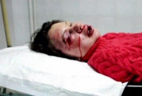 烏克蘭揭黑女記者遭毒打 或因揭露高官私建豪宅 烏克蘭揭黑女記者遭毒打 或因揭露高官私建豪宅