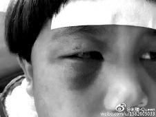 6月2日，網(wǎng)曝渭南市臨渭區(qū)一不滿5歲的女童遭奶奶毆打，眼圈青腫，引起網(wǎng)友關(guān)注，但孩子父母和爺爺均稱是摔倒導(dǎo)致。相關(guān)部門介入調(diào)查發(fā)現(xiàn)確為奶奶毆打所致，鑒于其身體原因已進(jìn)行批評(píng)教育。