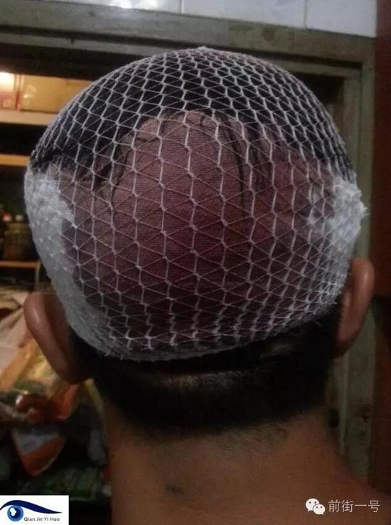 李律師受傷后縫合三針。