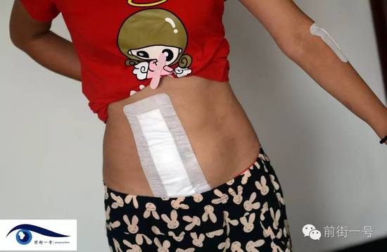 小金腹部的傷口。