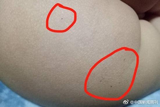 據(jù)多名紅黃藍(lán)(新天地分園)家長(zhǎng)反映，孩子腿部、屁股、腋下出現(xiàn)針眼。