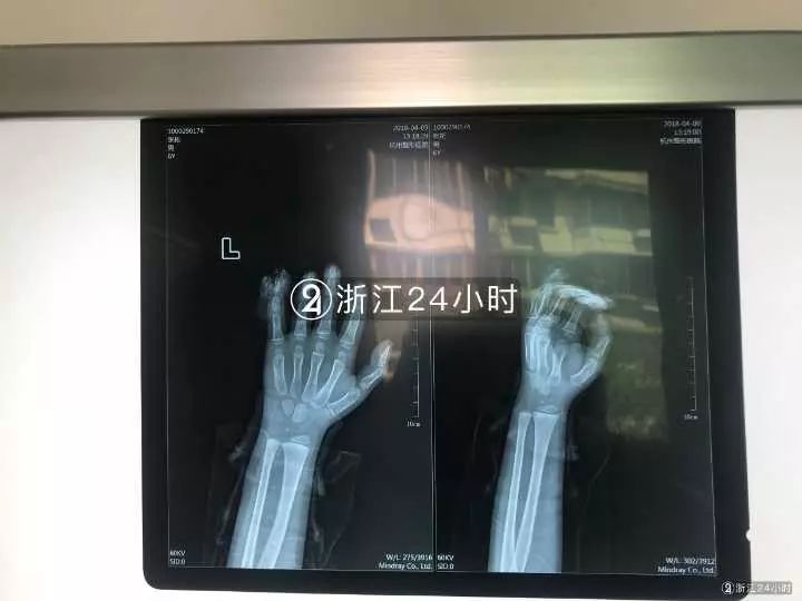 嚇哭！6歲男孩被夾斷手指 罪魁禍首竟是校服