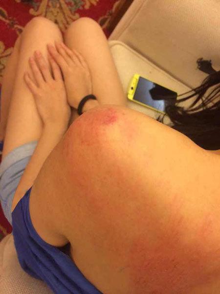 “跑男”真的很拼！baby朋友圈曬后背紅腫照