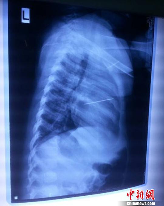 河南心臟被扎針女?huà)胄g(shù)后尚未脫險(xiǎn)家人渴求真相 河南心臟被扎針女?huà)胄g(shù)后尚未脫險(xiǎn)家人渴求真相