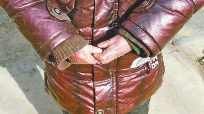 長(zhǎng)期受損的手指，已經(jīng)長(zhǎng)在了一起。