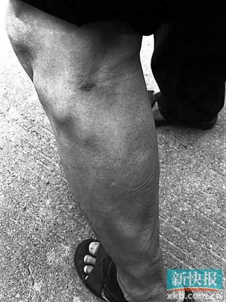 傷者身上遺留的彈痕。