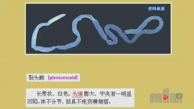 少女大腦皮層萎縮 醫(yī)生從她腦子里捉出5厘米蟲子 少女大腦皮層萎縮 醫(yī)生從她腦子里捉出5厘米蟲子