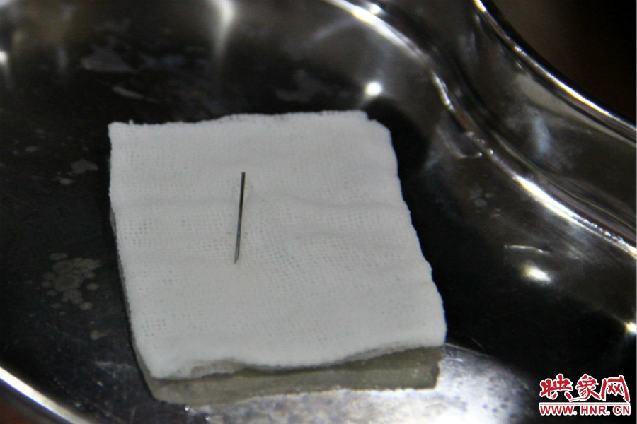 上午11點30分許，小龍腦中鋼針已經成功取出。