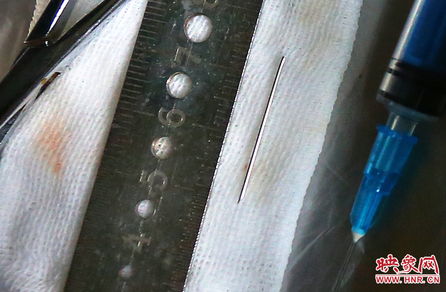 上午11點42分，大龍顱內(nèi)的鋼針被取出