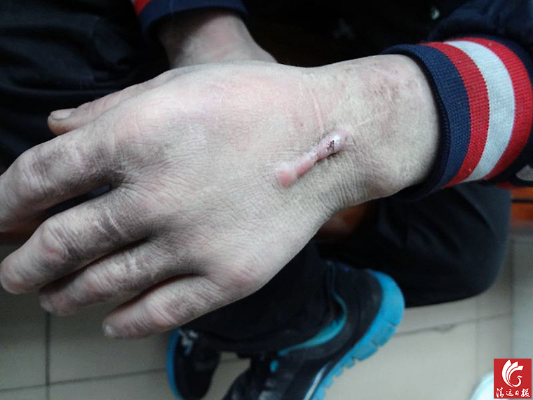 被發(fā)現(xiàn)男子手上的傷疤。