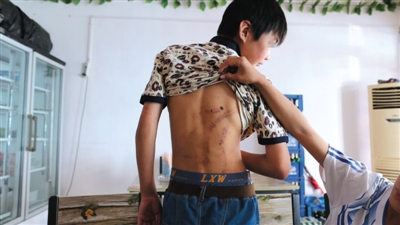 　昨日，奶西村，被打的小剛后背上條條瘀痕依然明顯。