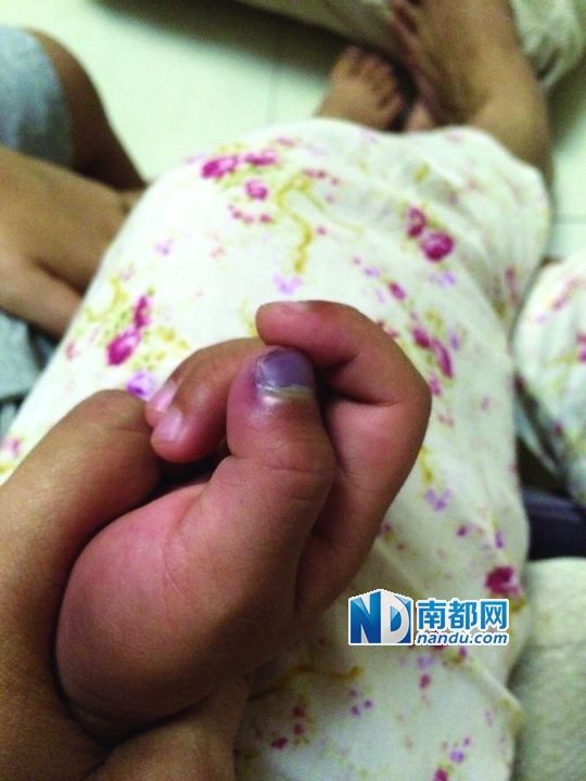 小逸手指被夾傷。