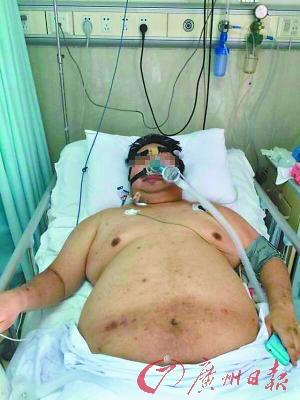 男子作息紊亂體重升至180公斤 搶救時(shí)壓塌2張病床 男子作息紊亂體重升至180公斤 搶救時(shí)壓塌2張病床