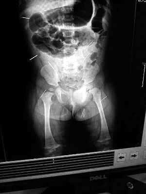 目前體內(nèi)的12根鋼針多分布在孩子的臀部，一根在腹部，其余3根在胸腔附近，其中一根很接近心臟