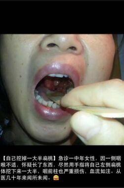 圖片來自市三醫(yī)院耳鼻喉科醫(yī)生朋友圈 圖片來自市三醫(yī)院耳鼻喉科醫(yī)生朋友圈