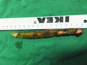 插入男子腦內(nèi)的樹枝。